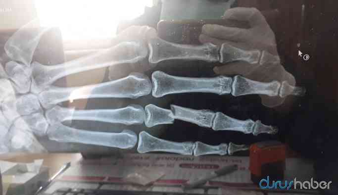Sınırda polis şiddeti: Göçmenin parmağını kırdı