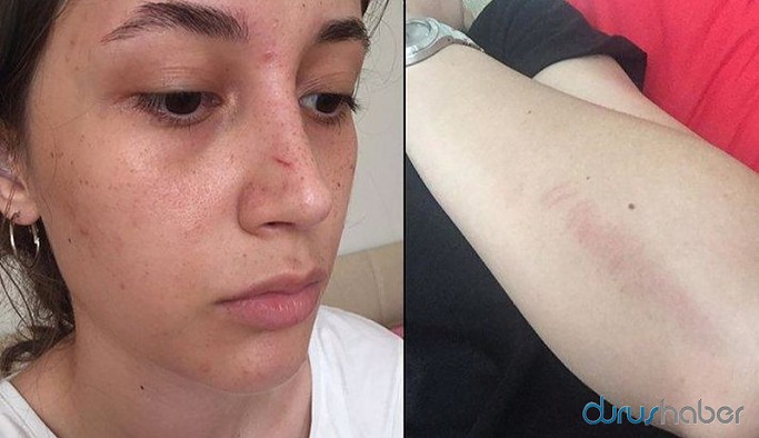 Şort giydiği için saldırıya uğradı, saldırgan serbest bırakıldı