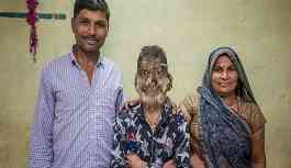 Hintli öğrenci ender görülen bir hastalık nedeniyle 'kurt adam'a dönüştü